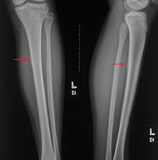 Image result for Tibia Stress Fracture