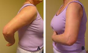 Image result for Lift-Off Subscapularis Test