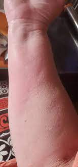 For anything more severe, you should see a doctor for treatment (which goes for chemical burns, too, which typically require. How To Treat A Veet Chemical Burn Quora