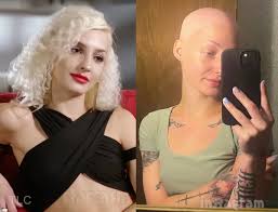 PLATHVILLE Moriah Plath lost all of her hair again, talks about alopecia struggles – Starcasm