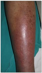 Image result for Erysipeloid