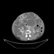Polycystic Liver Disease Radiology Case Radiopaedia Org