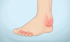 Psoriatic Arthritis Doctors Australia