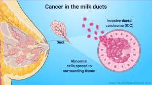 Image result for breast cancer