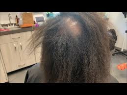 How To Fix Damaged Hair Bald Spot In Middle Plus More Youtube Bald Hair Damaged Hair Middle Hair