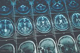 Manage these post covid cardiovascular. Avoid Mri Scans On Covid 19 Patients Unless Necessary