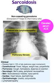 Lupus pernio is a serious skin condition that sarcoidosis may cause. Sarcoidosis Non Caseating Granulomas Composed Of Grepmed