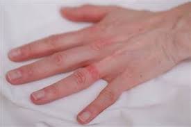Wedding Ring Rash A Real Life Seven Year Itch Nbcnews Com Wedding Ring Allergy Wedding Ring Rash Rash On Hands