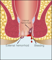 Covenient and economic treatment // j. Haemorrhoid Removal Surgery Johannesburg Haemorrhoidectomy