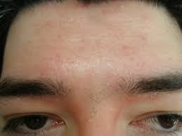 Dermatita Seboreica Syromed Clinica Ginecologie Urologie Bucuresti