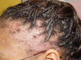 Jack black nourishing hair & scalp conditioner. Managing Natural Hair And Scalp Seborrhoeic Dermatitis For Long Healthy Natural Kinky And Curly Hair Your Dry Hair Days Are Over