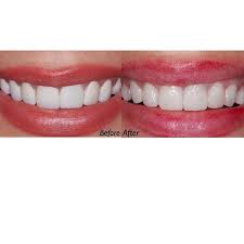 They are placed to the front of teeth and improve their look. Pin On Smile Make Overs