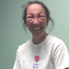 Now We Know What Happens When You Get Poison Ivy in Your Eyes