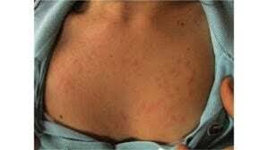 Image result for polymorphous eruption