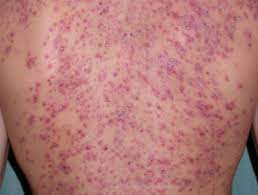 Neisseria meningitidis and purpura fulminans in a woman with. Acne Fulminans Dermnet Nz