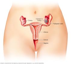 In addition to a loss of appetite, early signs of ovarian cancer include feeling full quickly and having difficulty finishing even small meals. Ovarian Cancer Symptoms And Causes Mayo Clinic