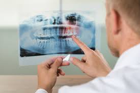 Do teeth grow back if you chip your tooth? 5 Possible Reasons Your Child S Permanent Teeth Aren T Coming In All Star Dental
