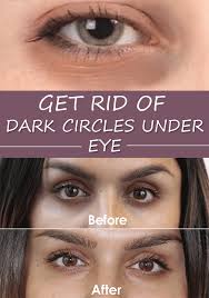 There Are Natural Remedies That Will Help You Reduce Dark Circles And Make The Skin Around The Eyes Gl Dark Circles Under Eyes Dark Circles Reduce Dark Circles