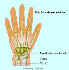 Dolor En La Mano Derecha Izquierda Al Escribir Al Despertar Dedos Muneca Y Palma