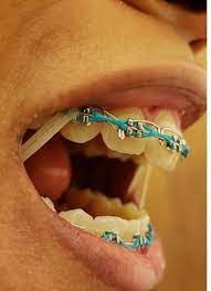 Braces Girlswithbraces Metalbraces Powerchain Elastics Braces Colors Teeth Braces Braces Tips