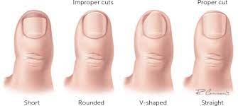 They should be licensed, and their certificates should be hanging on the wall as. Ingrown Toenail Management American Family Physician