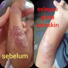 Dah pasang semua jenis ubat nyamuk. Kudis Gatal Bernanah Berair Sinoskin Spray Kota Tinggi Facebook