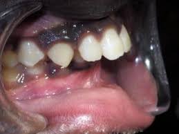 In this condition, your upper teeth protrude over your lower teeth. Braces Before And After Overbite Causes Symptoms Treatments