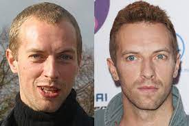 Best Hair Transplant In Turkey 6 Best Hair Transplant Hair Transplant Cool Hairstyles