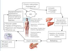 Image result for Refeeding Syndrome