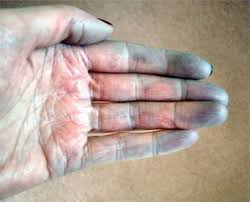 Image result for raynauds photo gif