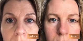 What is the best vitamin c serum? Absolute Collagen Before And After Pictures Incredible Results