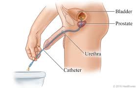 Image result for Urethral Catheterization