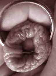 File:Transgender intimate jewelry of a woman's penis - ringing of the  foreskin with ring of platinum.jpg - Wikimedia Commons