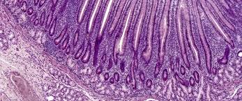 Image result for Intestinal Enteropathy