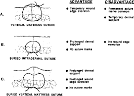 Check spelling or type a new query. Buried Vertical Mattress Suture Zitelli 1989 The Journal Of Dermatologic Surgery And Oncology Wiley Online Library