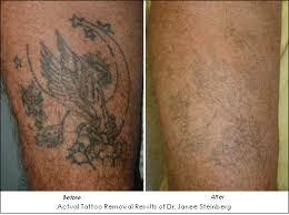 🟠 laser tattoo removal & fading since 2012 🟠 allentown, pa 🟠 $200 / treatment 🟠 no dms please ⬇️ book appts + more linktr.ee/gotattooremoval. Laser Tattoo Removal Keeps Your Past Out Of Your Present Ahb