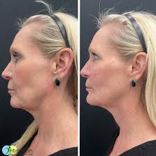 ✨Subtle lift, major impact ✨ This transformation was achieved using  Radiesse® to stimulate collagen and elastin in the mid-face and  chin—lifting, brightening, and improving projection. We also used  hyper-dilute Radiesse® to restore