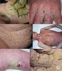 Image result for scabies in the groin area