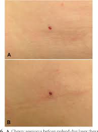 Most people who have cherry angiomas may choose to have. Figure 6 From Immediate Skin Responses To Laser And Light Treatments Therapeutic Endpoints How To Obtain Efficacy Semantic Scholar