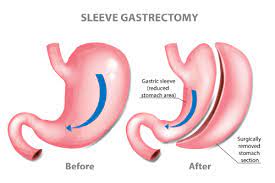 Maybe you would like to learn more about one of these? How To Get Weight Loss Surgery Approved Jet Medical Tourism In Mexico