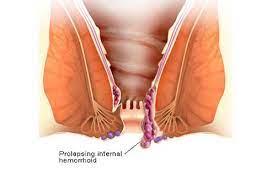 Hemorrhoids are the most common diseases of the rectum. How To Get Rid Of Hemorrhoids Types Causes And Treatments