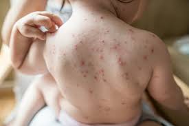 Image result for Varicella zoster on human skin