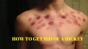 Check spelling or type a new query. How To Get Rid Of A Hickey Fast And Easy Youtube