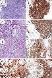Monoclonal anti‐cea, aua‐1, ca19.9 and leum1 labelled no malignant mesotheliomas and were positive in 10 (71%), nine (64%), eight (57%) and six (43%) of 14 cases of adenocarcinoma. A Modified Vimentin Histological Score Helps Recognize Pulmonary Sarcomatoid Carcinoma In Small Biopsy Samples Anticancer Research