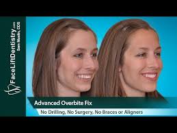 There's a common drive for people to want to fix an overbite for cosmetic reasons. Overbite Fix No Braces No Aligners No Surgery 8 Days