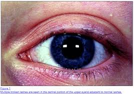 They are falling out because the pores are swollen and red for past 7 yea. Eyelashes Falling Out 7 Reasons Why Treatment Tips