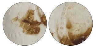 = sarcina care nu se localizeaza in cavitatea uterina: Lichid Maro Inchis DescÄƒrcarea De Maro La Femei Motivele Scurgere VaginalÄƒ Maro Inchis Tratament