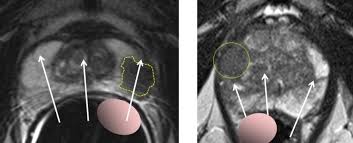There are a number of different treatments doctors recommend. All For One A Belgian Prostate Unit At Work Healthcare In Europe Com