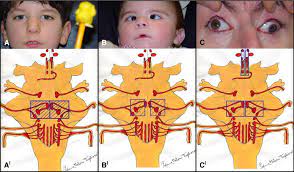 Nord gratefully acknowledges john b. Ophthalmologic And Systemic Features In Mobius Syndrome Ophthalmology