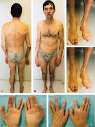 We did not find results for: Muscle Myopathy Types Causes Symptoms Diagnosis Treatment